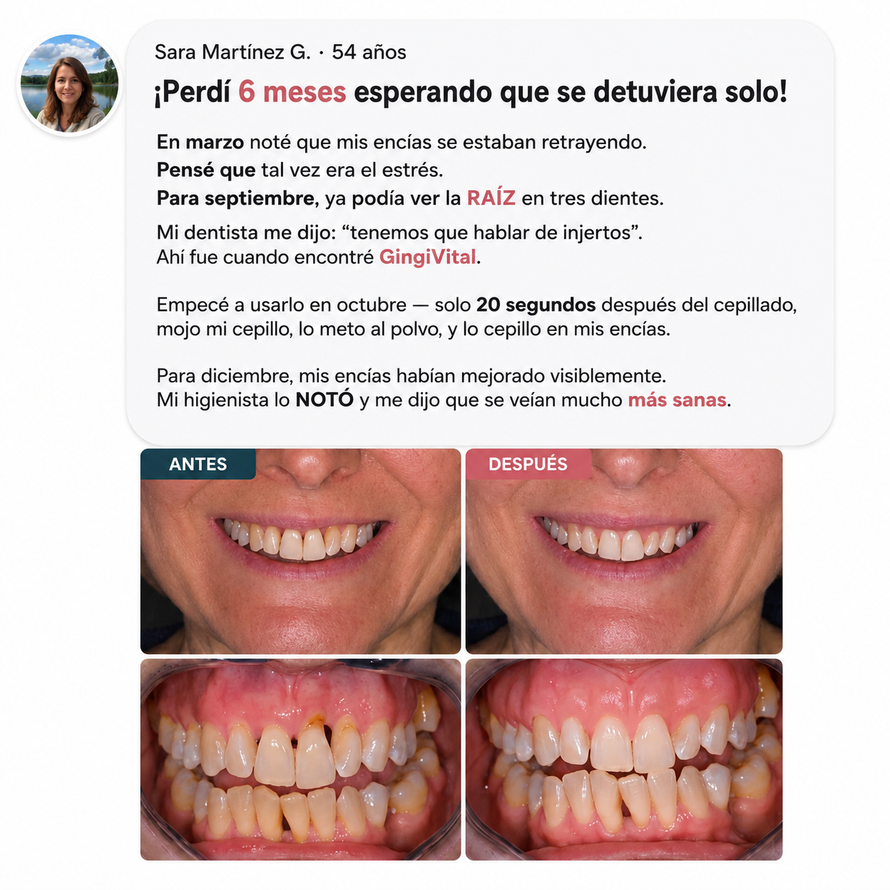 GingiVital© Polvo de Colágeno para Encías